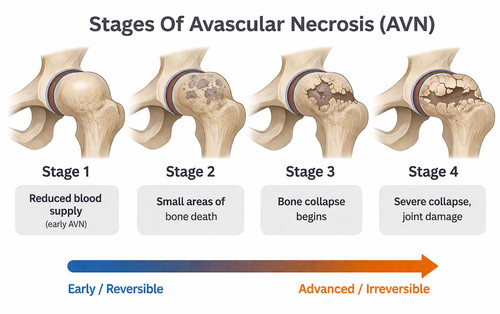 avascular necrosis avn hip stages 1 to 4 diagram.jpg