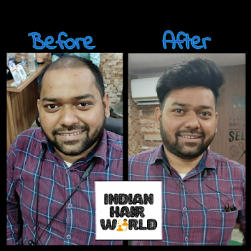 Non Surgical Hair Replacement center Kolkata | Indian Hair World.png