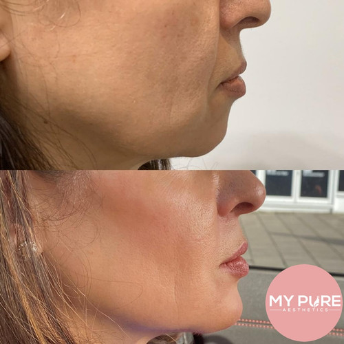 Chin Fillers Near Me.jpg