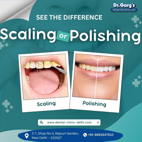 See the Difference with Scaling at Dr. Garg’s Multispeciality Dental Center.jpg