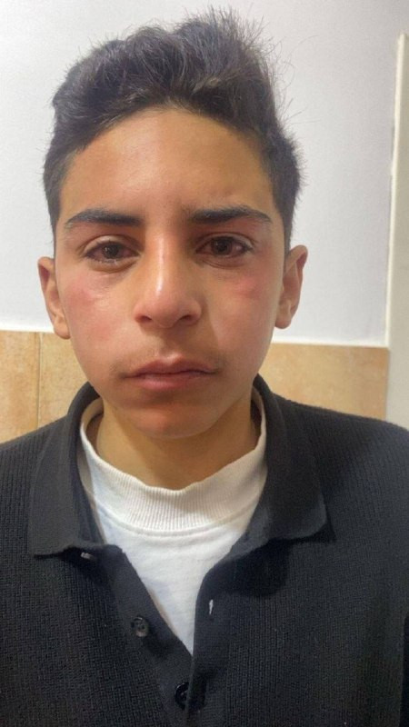 أصيب الطفل محمد رامي صلاحات، جراء اعتداء نفذته مجموعات من المستوطنين، حيث قاموا برش غاز الفلفل على ركاب إحدى المركبات أثناء مرورها على طريق خلايل اللو...