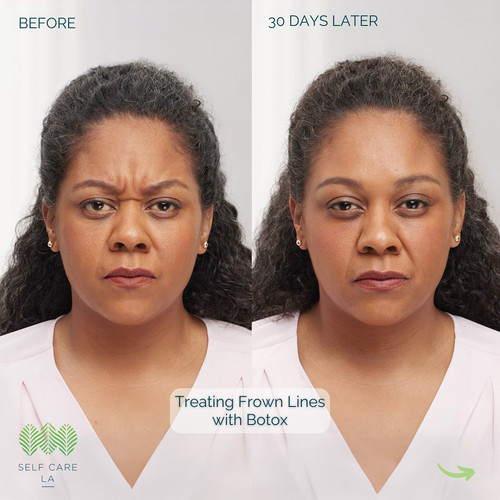 Microneedling Santa Monica CA.jpg
