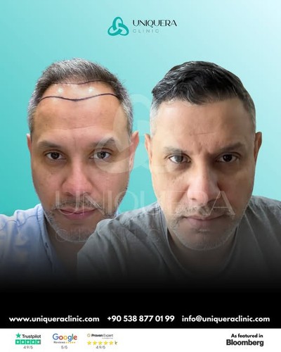 Best Hair Loss Treatment for Receding Hairline – Uniquera Clinic.jpg