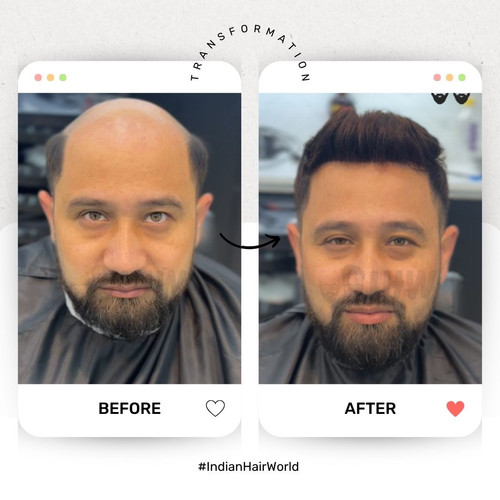 Hair Patch in Siliguri  - Indian Hair World Siliguri.jpg