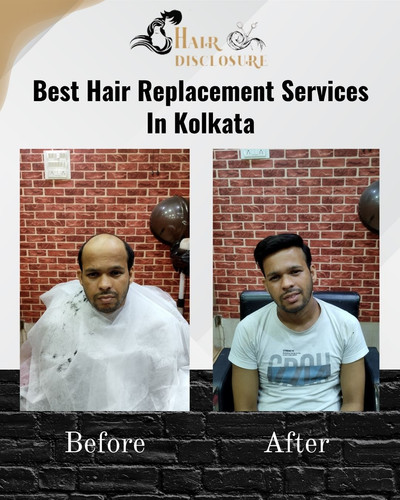Best hair Replacement services in kolkata - Hair Disclosure.jpg