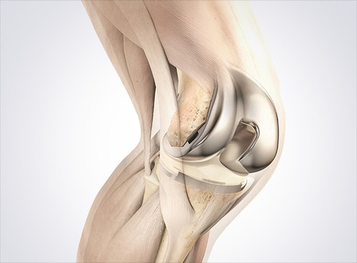 Total Knee Replacement Surgery in Indore.jpg