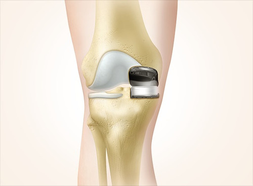 Partial Knee Replacement Surgery in Indore.jpg