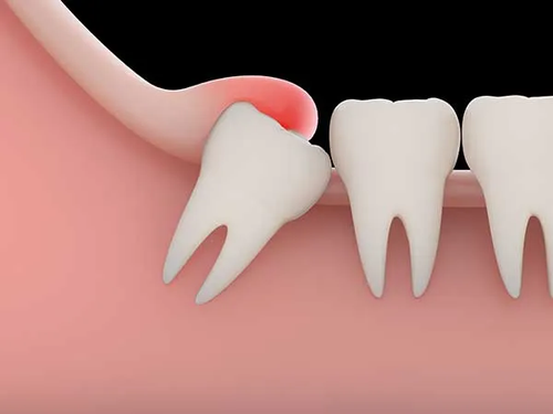 Wisdom Teeth Removal Melbourne.png