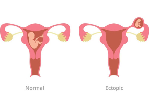 Ectopic Pregnancy Care in Indore.jpg
