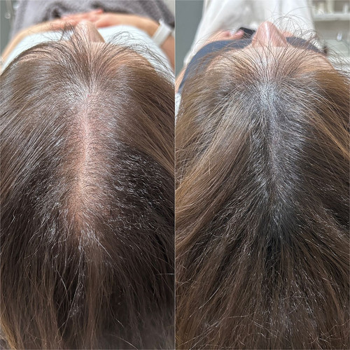 Best Hair Weaving Clinic in Ghaziabad | Affordable Hair Weaving Services.jpg