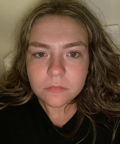 any surgeries to fix uneven asymmetrical eyes v0 p6ctubtme8d91.jpg