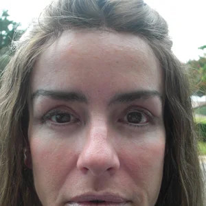 Lori Keep Facial after with bleph canthopexy and facial fat injections 33742.jpg