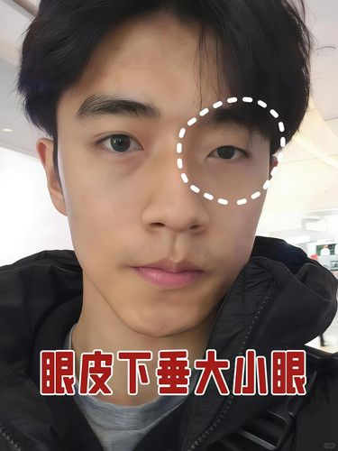眼皮下垂？后悔没早点发现 1 鲨不拉吉 来自小红书网页版.jpg
