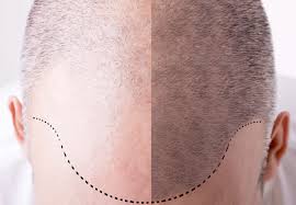 Robotic Hair Transplant in India | Advanced FUE at MedLinks Hair Transplant.jpg