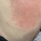 Stomach Day 8 of Doxy new line mark at bottom side separate