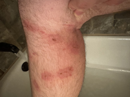 Leg Day 8 Doxy, wounds finally drained but redness spread behind knee around day 6.jpg