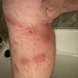 Leg Day 8 Doxy, wounds finally drained but redness spread behind knee around day 6