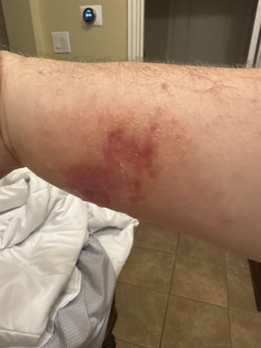 48-55 hours after starting doxy forearm.jpg