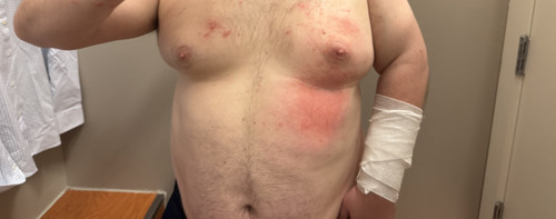 Day 6 of chest, heavy fluid buildup on right breast.jpg
