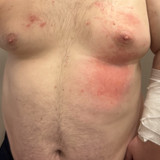 Day 6 of chest, heavy fluid buildup on right breast