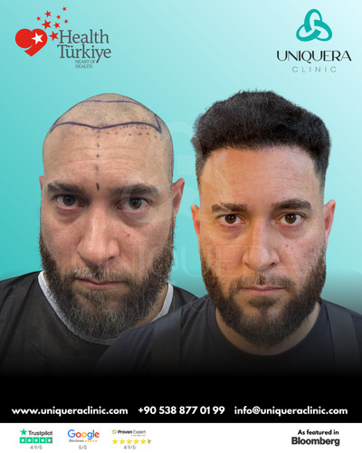Best Turkey Hair Transplant Clinic for Natural Results – Uniquera Clinic.jpg