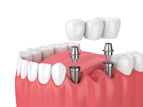 Dental Implants in Ahmedabad | Daivik Dental Clinic.jpg