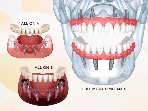 Dental Implants in Delhi NCR.jpg