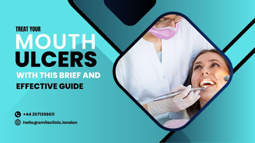 Treat Your Mouth Ulcers with This Brief and Effective Guide.jpg