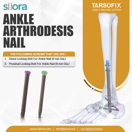 Ankle Arthrodesis Nail.jpg