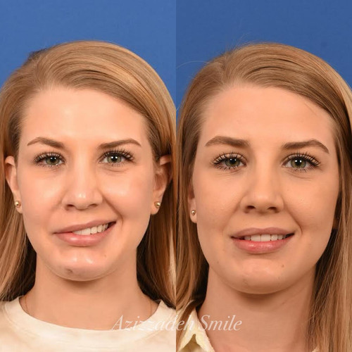 Bell's Palsy Surgeon CA.jpg