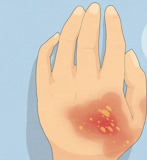 How to Treat Burns from Hot Water, Oil, or Hot Iron ?