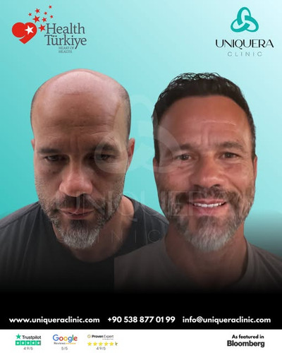 Luxury Hair Transplant Turkey – Uniquera Clinic.jpg