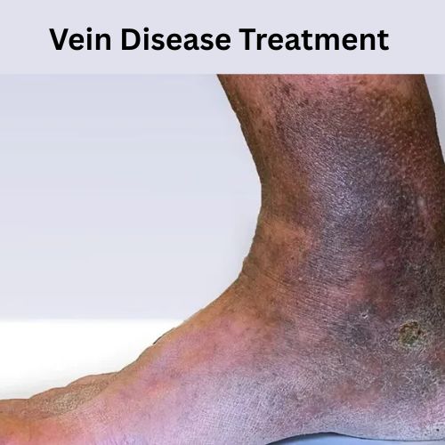 Modern Vein Disease Treatment Services You Can Trust.jpg