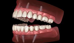 All-on-X Implant Dentures Republic MO - Permanent Smile Restoration.jpg