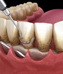 Periodontal Treatment North Olmsted -Gum Disease Care & Therapy.jpg