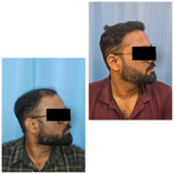 Hair transplant results