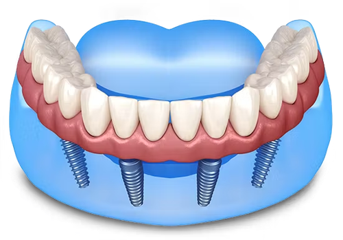 dental implants provider.png