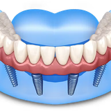 dental implants provider