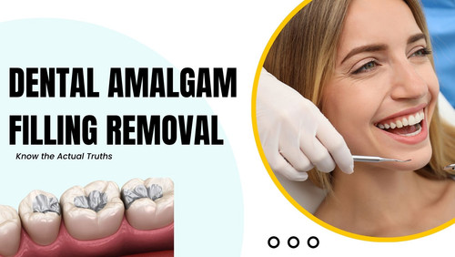 Dental Amalgam Filling Removal Know the Actual Truths.jpg
