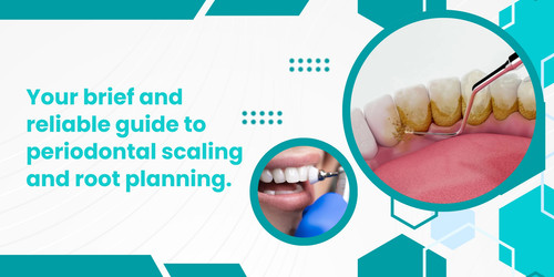 Your brief and reliable guide to periodontal scaling and root planning.jpg