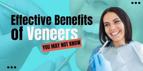 Top 10 Effective Benefits of Veneers You May Not Know.jpg