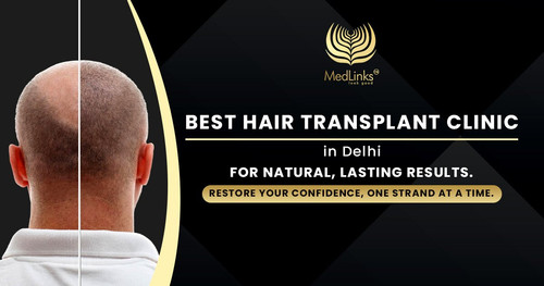 Best Hair Transplant Cost in Delhi | Medlinks Hair Transplant Experts.jpg