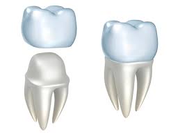 Wennersten Dental Care | Dental Implant Crowns Ann Arbor.1