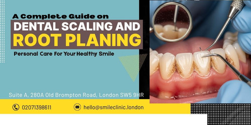 A Complete Guide on Dental Scaling and Root Planing.jpg