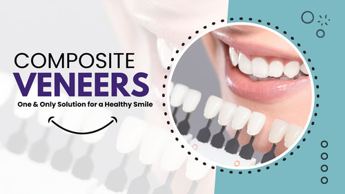 Composite Veneers One & Only Solution for a Healthy Smile.jpg