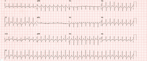 taquicardia intranodal tipica ekg.png