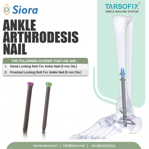 Ankle Arthrodesis Nail.jpg