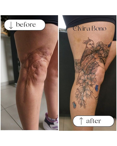 6a4f55dab9c71 extensive scar tattoo due to traffic accident 700 bordered.jpg