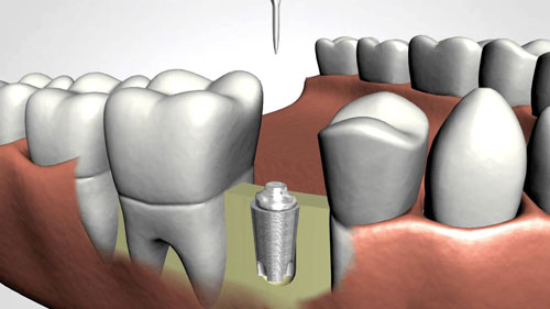 Dentist Bayside | Queens Dental implants - Wasserman Family Dentistry.jpg