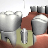 Dentist Bayside | Queens Dental implants - Wasserman Family Dentistry